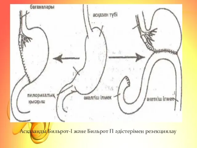 Асқазанды Бильрот-І және Бильрот П әдістерімен резекциялау