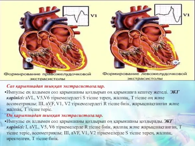 Сол қарыншадан шыққан экстрасистолалар. Импульс ең алдымен сол қарыншаны қоздырып