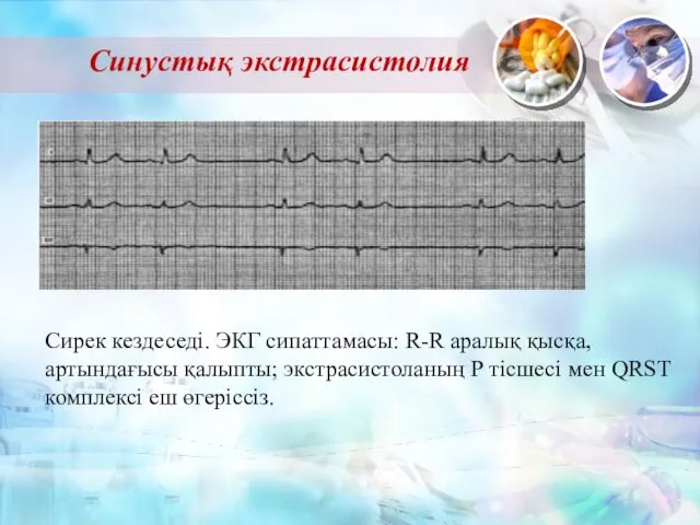 Синустық экстрасистолия Сирек кездеседі. ЭКГ сипаттамасы: R-R аралық қысқа, артындағысы