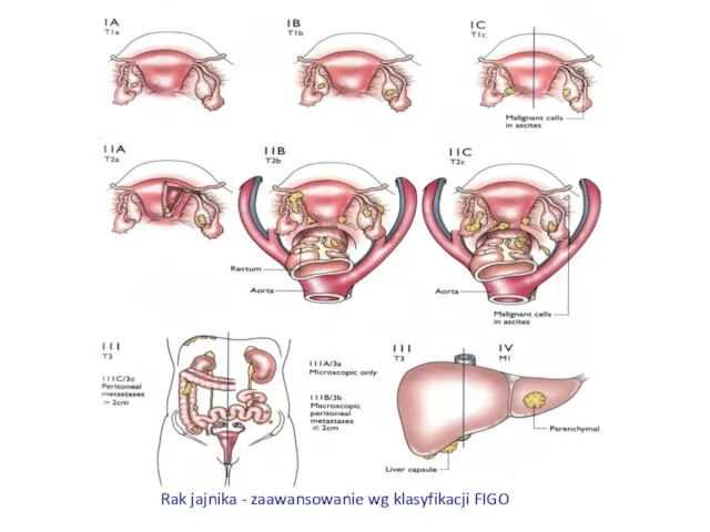 Rak jajnika - zaawansowanie wg klasyfikacji FIGO