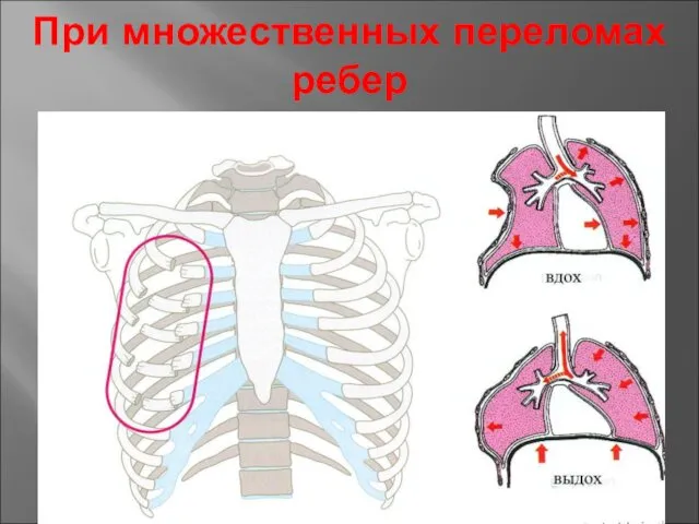 При множественных переломах ребер