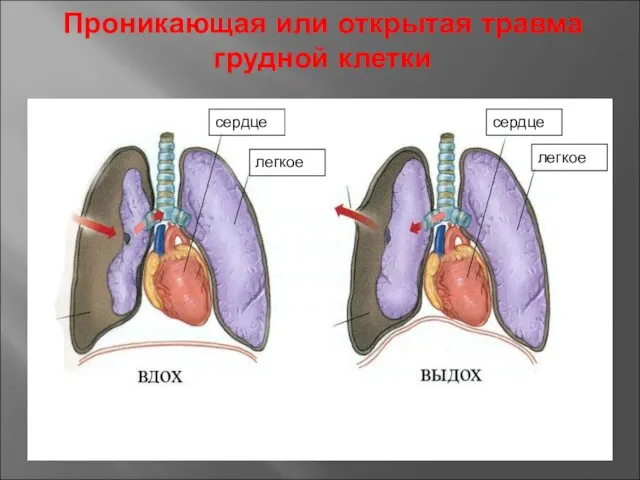 Проникающая или открытая травма грудной клетки сердце легкое легкое сердце