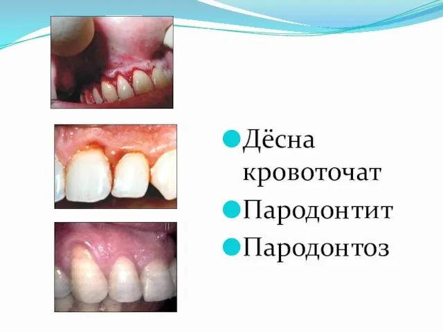 Дёсна кровоточат Пародонтит Пародонтоз