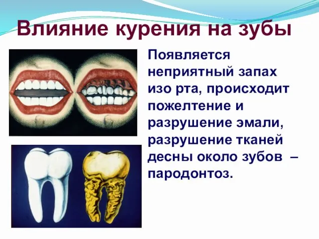 Влияние курения на зубы Появляется неприятный запах изо рта, происходит