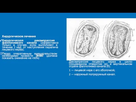 Хирургическое лечение Хирургическая декомпрессия фаллопиевого канала (эффективна только в случае,