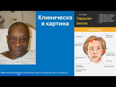 Клиническая картина Differentiating Facial Weakness Caused by Bell’s Palsy vs.