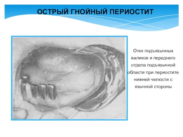 Отек подъязычных валиков и переднего отдела подъязычной области при периостите
