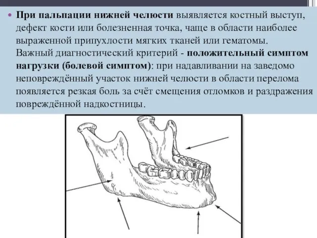 При пальпации нижней челюсти выявляется костный выступ, дефект кости или