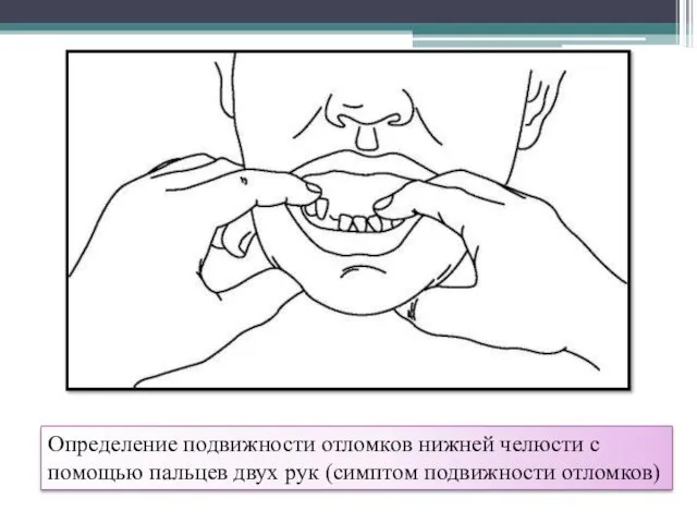 Определение подвижности отломков нижней челюсти с помощью пальцев двух рук (симптом подвижности отломков)