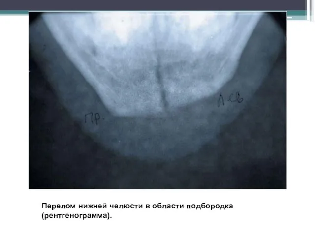 Перелом нижней челюсти в области подбородка (рентгенограмма).