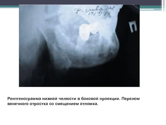 Рентгенограмма нижней челюсти в боковой проекции. Перелом венечного отростка со смещением отломка.
