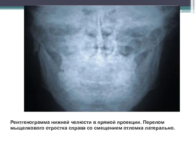 Рентгенограмма нижней челюсти в прямой проекции. Перелом мыщелкового отростка справа со смещением отломка латерально.