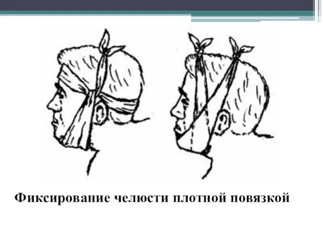 Фиксирование челюсти плотной повязкой