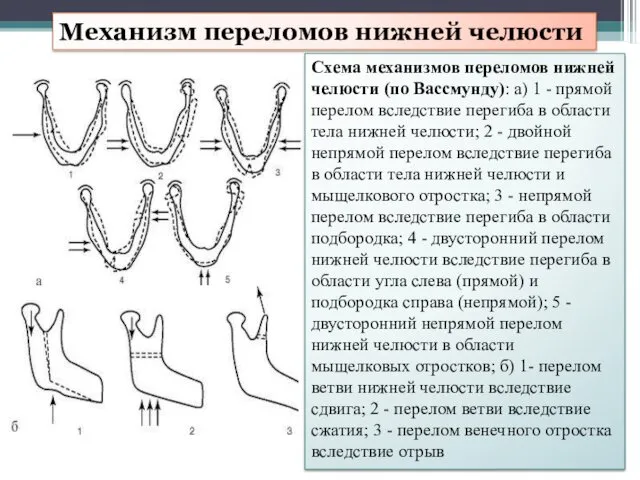 Механизм переломов нижней челюсти Схема механизмов переломов нижней челюсти (по