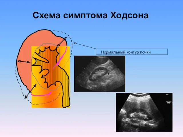 Схема симптома Ходсона