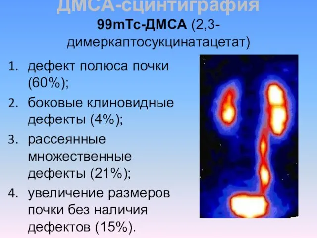 ДМСА-сцинтиграфия 99mТс-ДМСА (2,3-димеркаптосукцинатацетат) дефект полюса почки (60%); боковые клиновидные дефекты