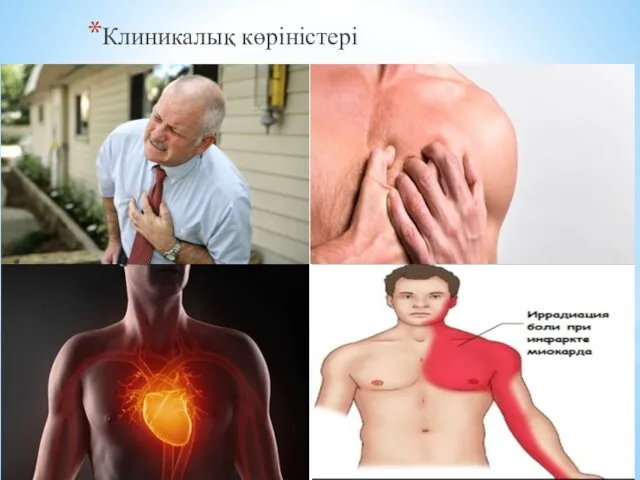 Клиникалық көріністері