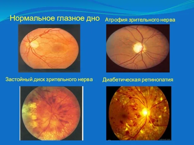 Нормальное глазное дно Застойный диск зрительного нерва Атрофия зрительного нерва Диабетическая ретинопатия