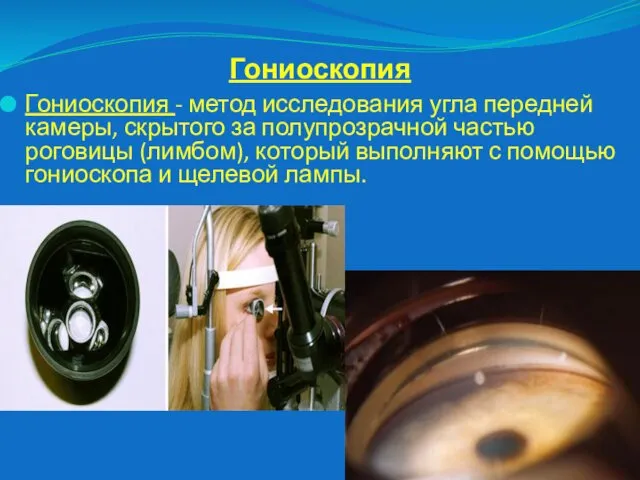 Гониоскопия Гониоскопия - метод исследования угла передней камеры, скрытого за полупрозрачной частью роговицы