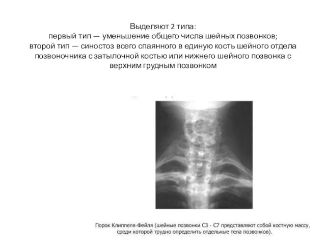 Выделяют 2 типа: первый тип — уменьшение общего числа шейных