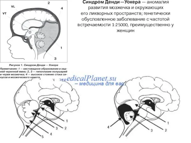 Синдром Денди—Уокера — аномалия развития мозжечка и окружающих его ликворных