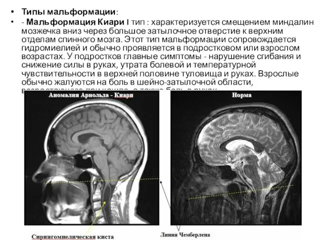 Типы мальформации: - Мальформация Киари I тип : характеризуется смещением