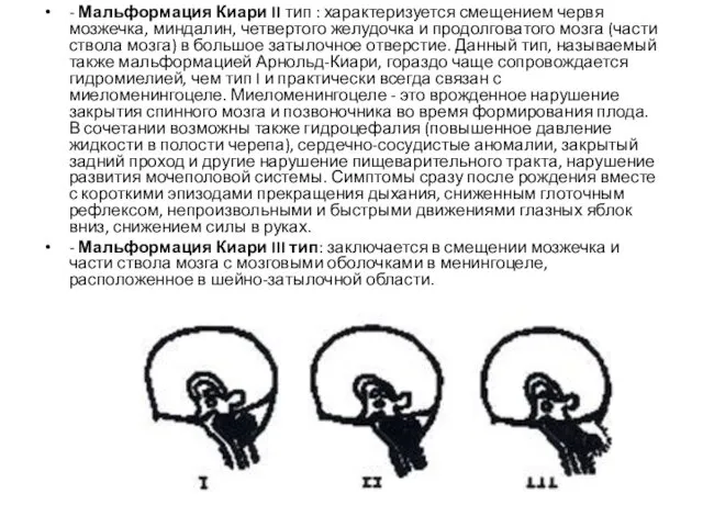 - Мальформация Киари II тип : характеризуется смещением червя мозжечка,