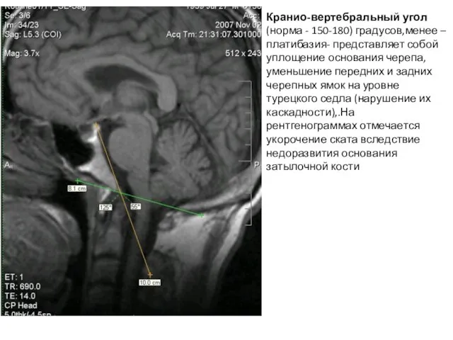 Кранио-вертебральный угол (норма - 150-180) градусов,менее –платибазия- представляет собой уплощение