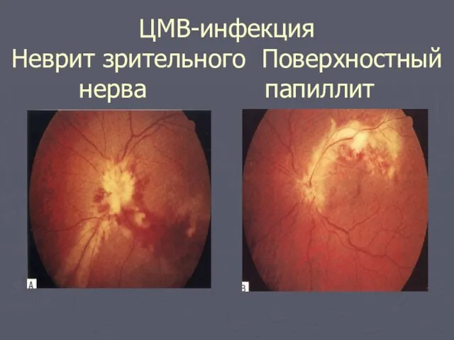 ЦМВ-инфекция Неврит зрительного Поверхностный нерва папиллит