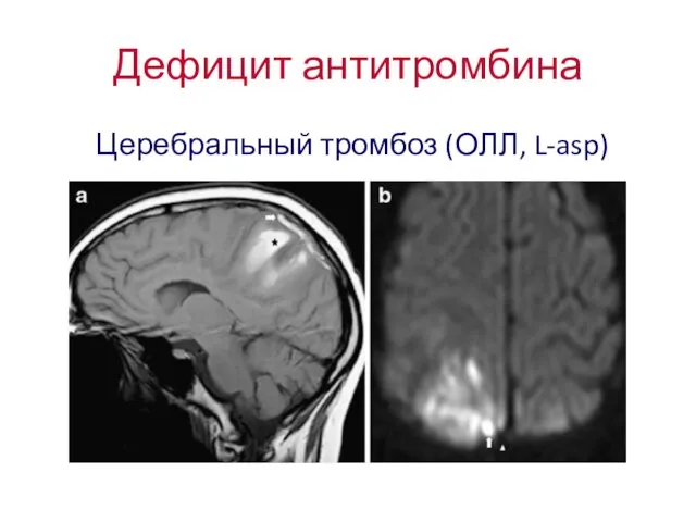 Дефицит антитромбина Церебральный тромбоз (ОЛЛ, L-asp)