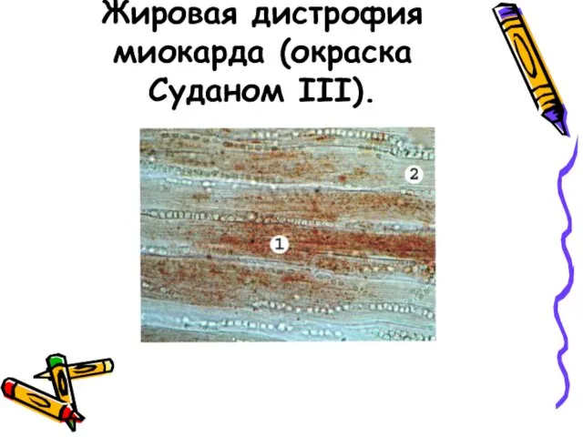 Жировая дистрофия миокарда (окраска Суданом III).
