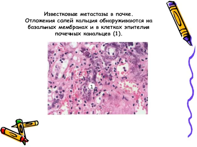 Известковые метастазы в почке. Отложения солей кальция обнаруживаются на базальных