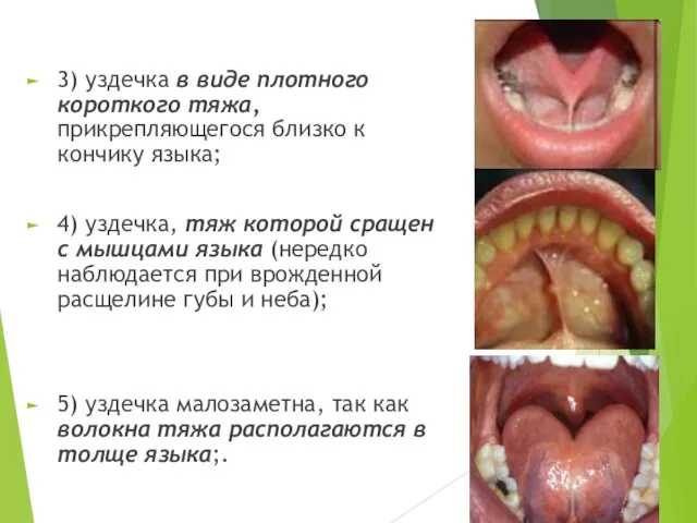 3) уздечка в виде плотного короткого тяжа, прикрепляющегося близко к