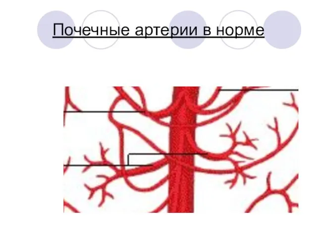 Почечные артерии в норме