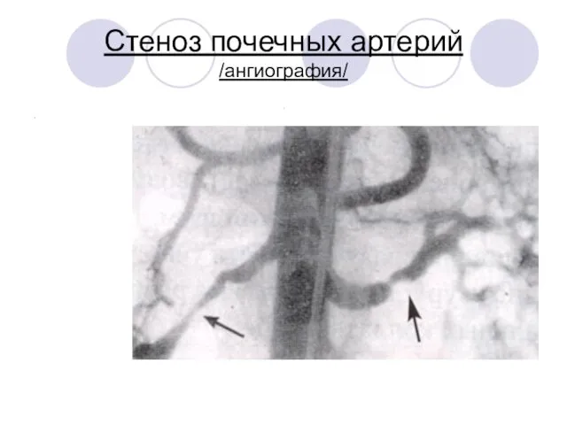 Стеноз почечных артерий /ангиография/ . .