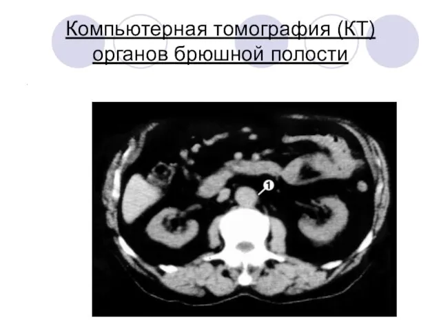 Компьютерная томография (КТ) органов брюшной полости .