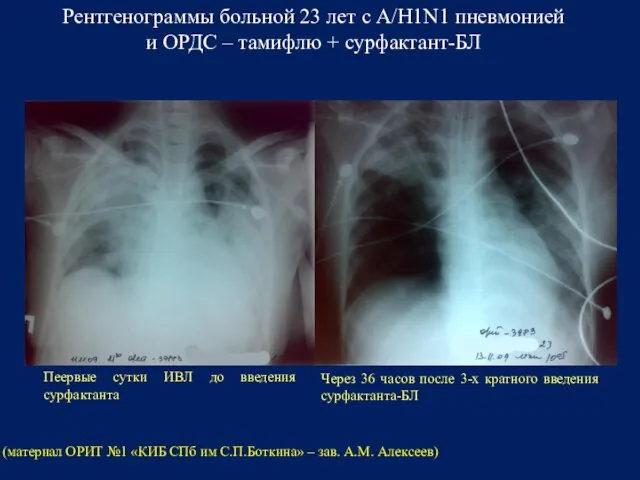 Рентгенограммы больной 23 лет с A/H1N1 пневмонией и ОРДС – тамифлю + сурфактант-БЛ