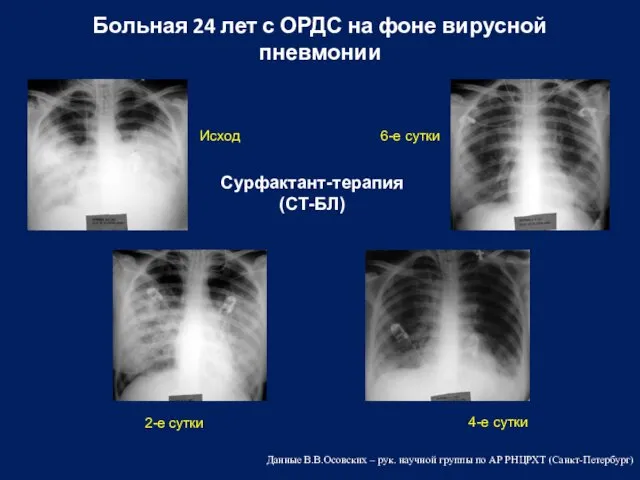 Больная 24 лет с ОРДС на фоне вирусной пневмонии Исход 6-е сутки 2-е