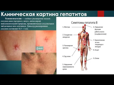 Клиническая картина гепатитов Телеангиэктазия — стойкое расширение мелких сосудов кожи (артериол, венул, капилляров)