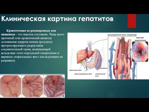 Клиническая картина гепатитов Кровотечение из расширенных вен пищевода – это опасное состояние. Чаще