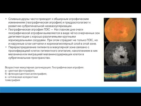 Сливные друзы часто приводят к обширным атрофическим изменениям (географическая атрофия)