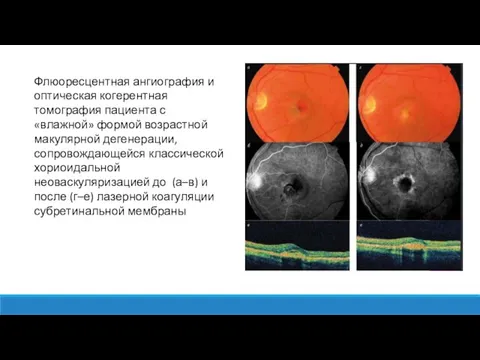Флюоресцентная ангиография и оптическая когерентная томография пациента с «влажной» формой