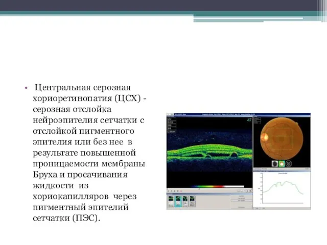 Центральная серозная хориоретинопатия (ЦСХ) - серозная отслойка нейроэпителия сетчатки с