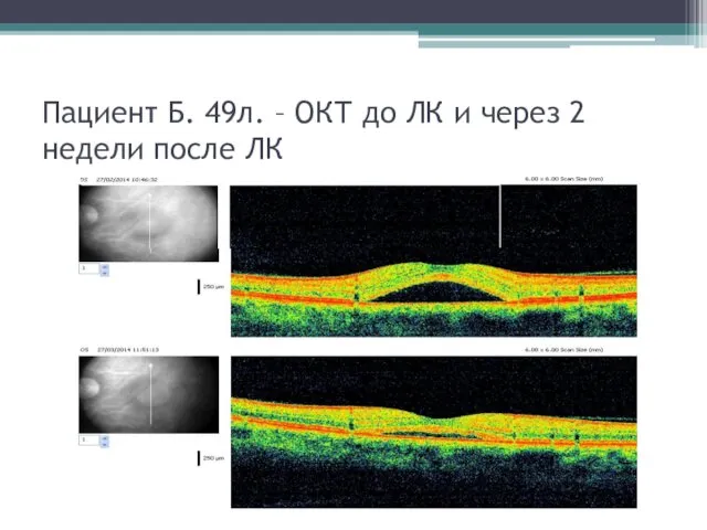 Пациент Б. 49л. – ОКТ до ЛК и через 2 недели после ЛК