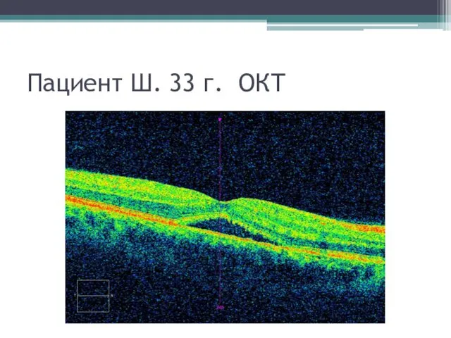 Пациент Ш. 33 г. ОКТ