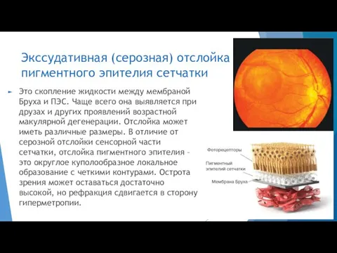 Экссудативная (серозная) отслойка пигментного эпителия сетчатки Это скопление жидкости между