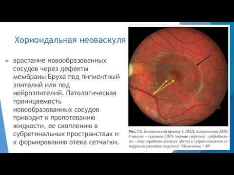 Хориоидальная неоваскуляризация врастание новообразованных сосудов через дефекты мембраны Бруха под