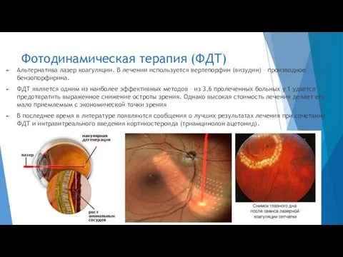 Фотодинамическая терапия (ФДТ) Альтернатива лазер коагуляции. В лечении используется вертепорфин