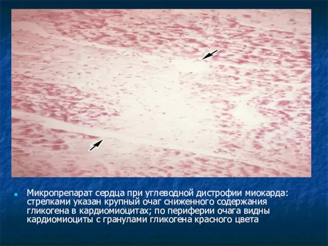 Микропрепарат сердца при углеводной дистрофии миокарда: стрелками указан крупный очаг сниженного содержания гликогена
