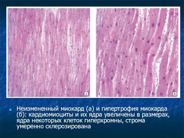 Неизмененный миокард (а) и гипертрофия миокарда (б): кардиомиоциты и их